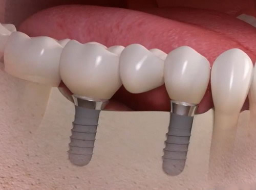 Kelių dantų implantavimo kaina