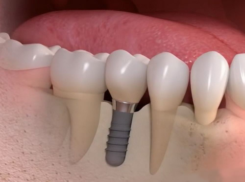 Vieno danties implantavimas